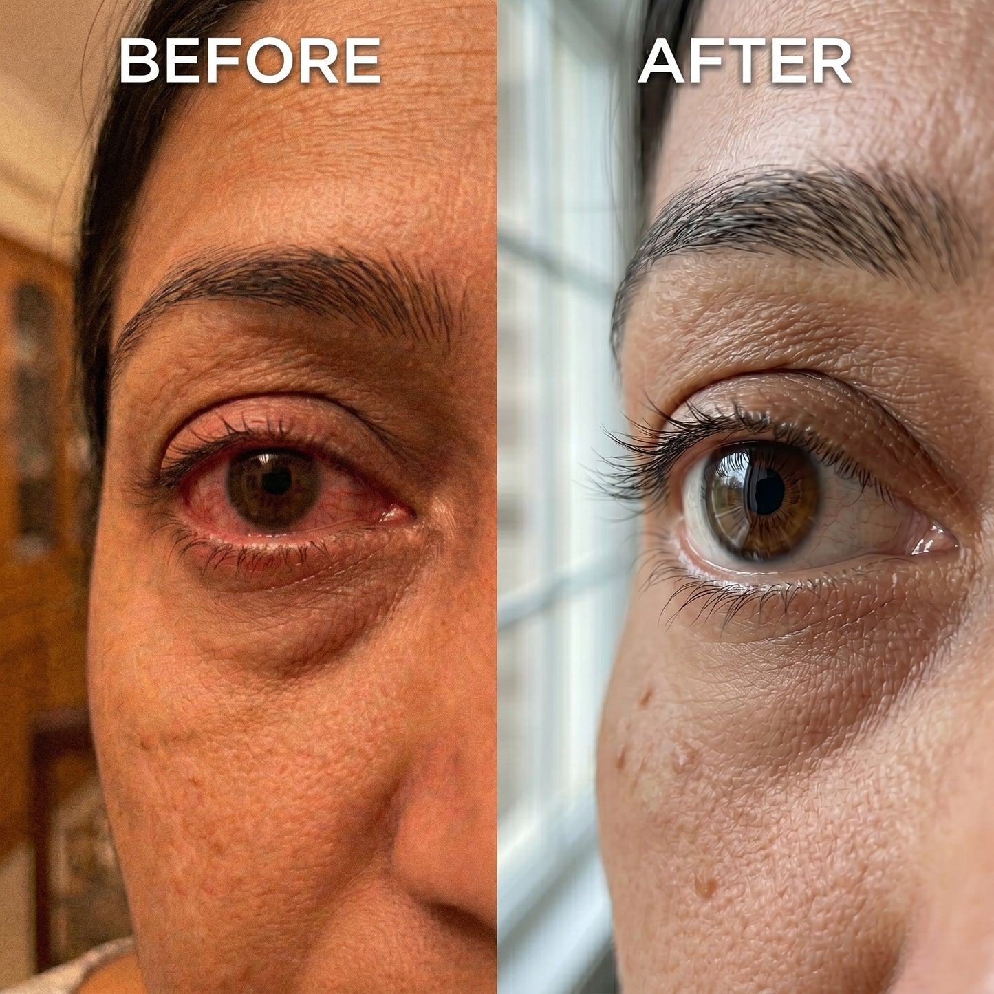 MediMist | Eye steam Therapy